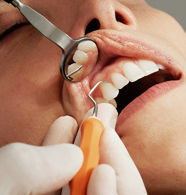 Nahansicht von der oberen Zahnreihe, während die Zahnzwischenräume gesäubert werdenNahansicht von der oberen Zahnreihe, während die Zahnzwischenräume gesäubert werden